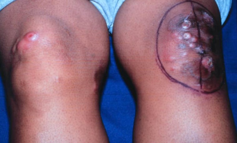 Nodules and tumors on a rash are signs of advanced CTCL.