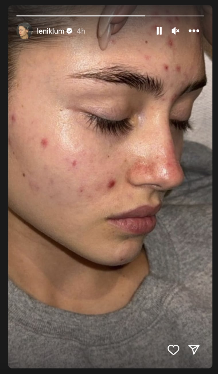 Keidi Klum's daughter, Leni, shared a photo of her acne breakout. 