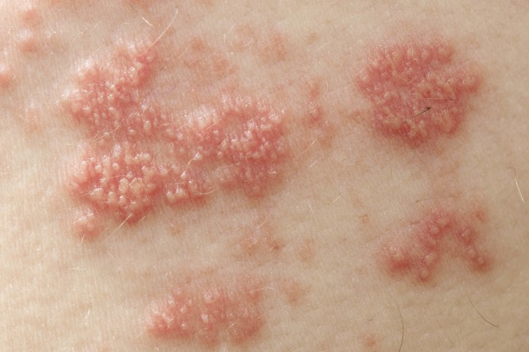 7 Signs a Skin Rash Could Indicate Something Serious