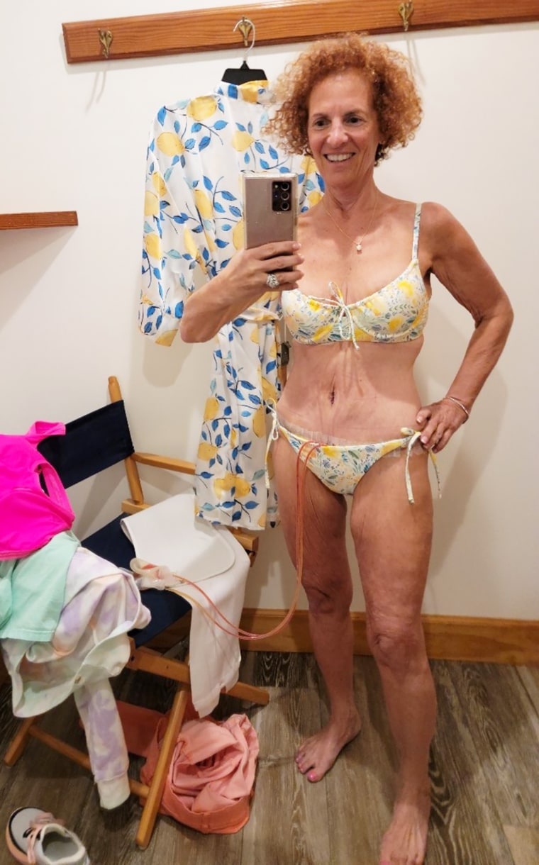 Only days after undergoing skin removal surgery, Sharon Shwartz felt thrilled to try on a bikini.