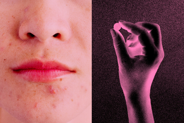 Photo Illustration: A woman with acne and a hand holding a round pill tablet