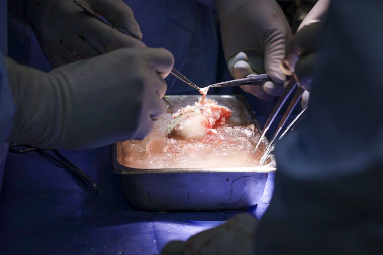 Surgeons prepare to transplant the pig kidney, seen here on ice, into the patient's body.