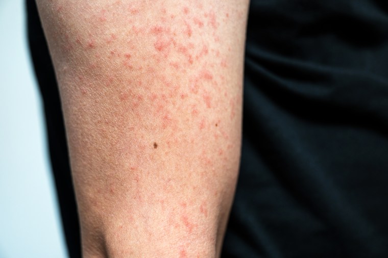 Dermatitis rash viral disease with immunodeficiency on arm of young adult