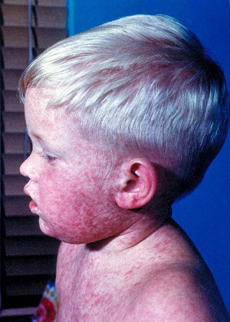 Measles rashes sometimes appear blotchy.