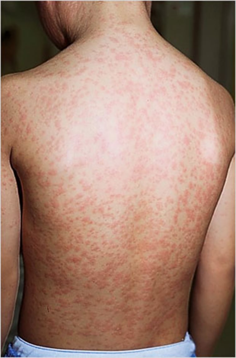 A measles rash.