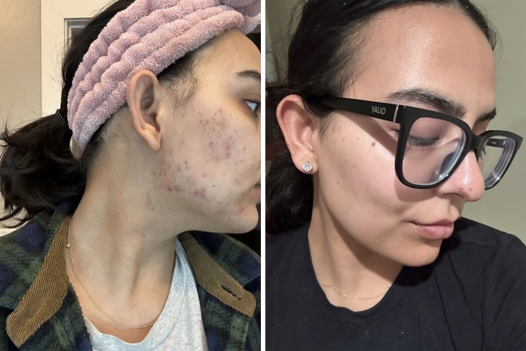 Before and after JJ Boparai started taking spironolactone to treat her acne.