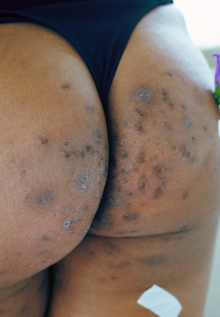 Hidradenitis suppurativa develops in skin fold areas such as under the arms, in the groin, under the breasts and on the butt.