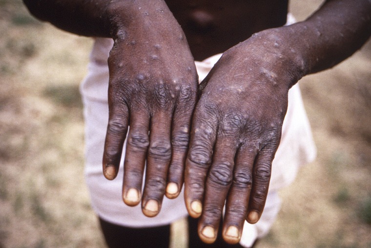 The dorsal surfaces of the hands of a monkeypox case patient.