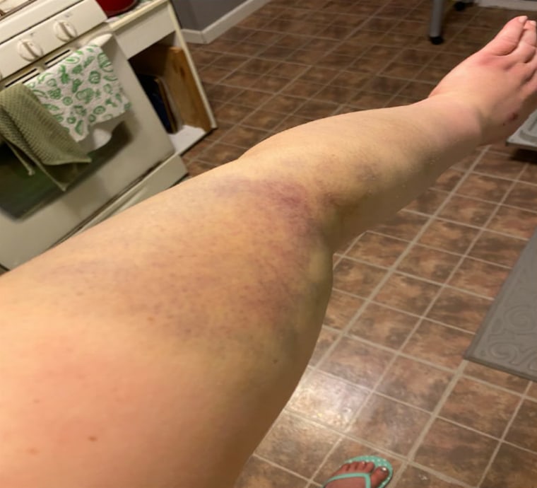 Bruising on Patty Day's arm