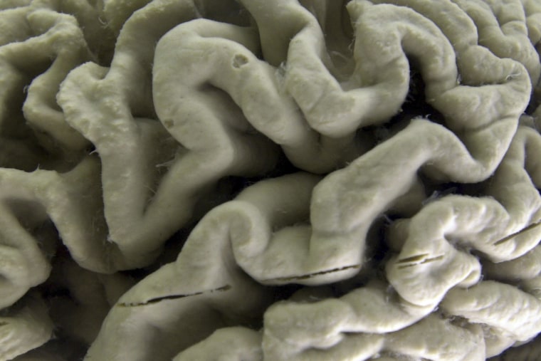 Imagen de archivo de una sección de un cerebro humano con enfermedad de Alzheimer, en Nueva York, el 7 de octubre de 2003. 