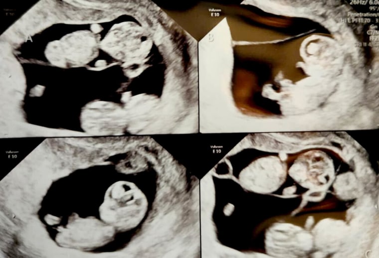 Couple welcomes identical quadruplet daughters
