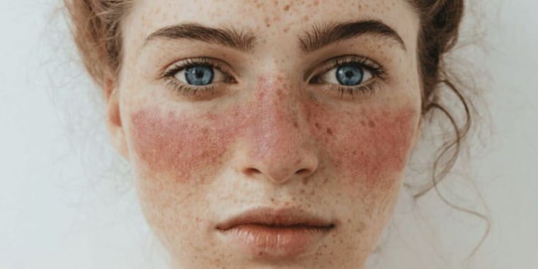 A butterfly-shaped (malar) face rash is a common sign of Lupus.