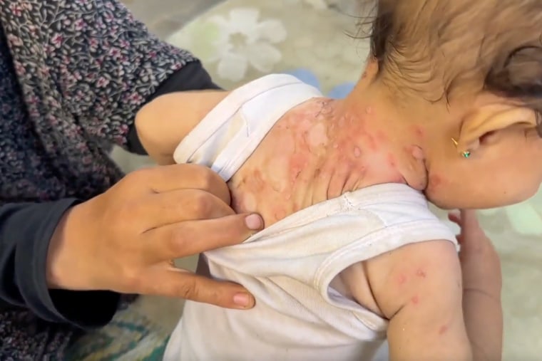 A kid with a rash.