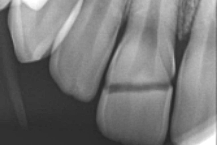 X-ray of Sabrina Jonas' tooth.