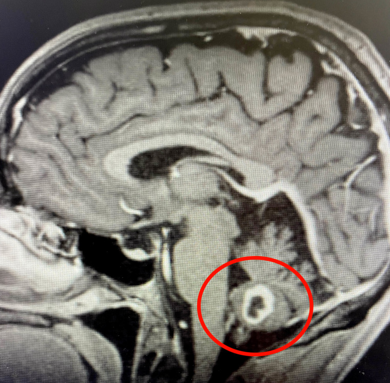 Eric Markowitz brain abscess