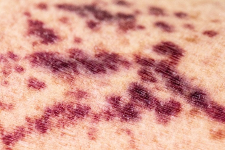 Cutaneous vasculitis or broken blood vessels on human skin.