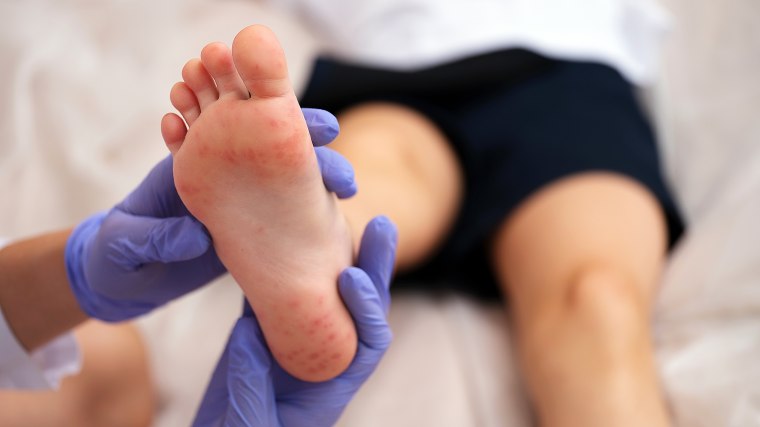 Coxsackie virus rash (hand, foot and mouth disease).