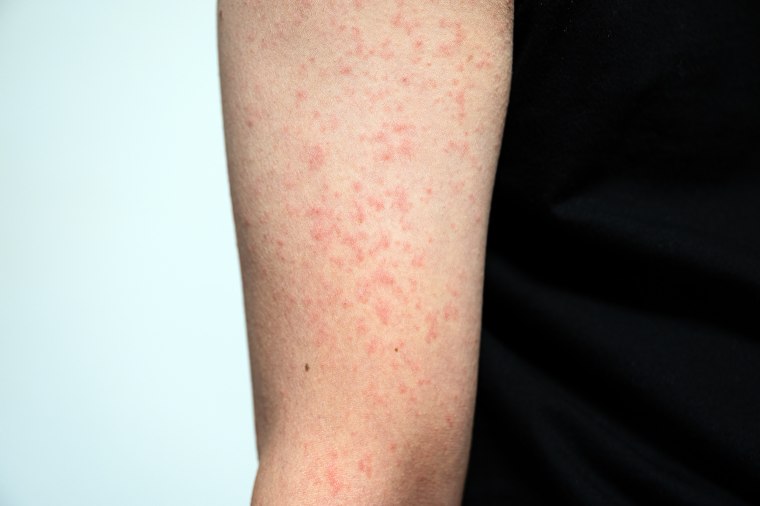 Viral exanthema rash (measles-like).