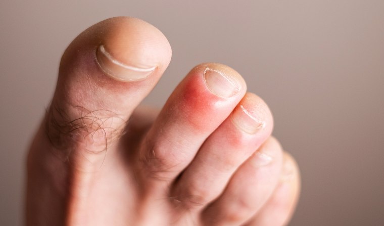 5 common skin rashes that can be caused by COVID, according to ...