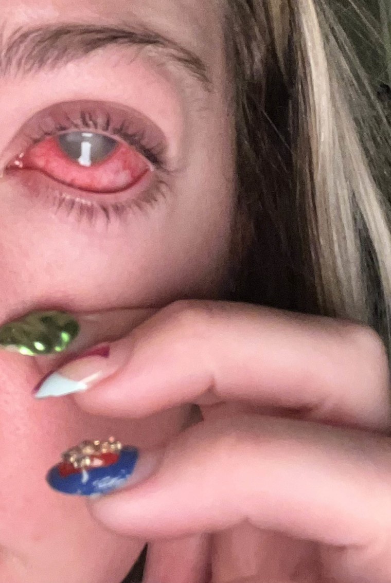 Brooklyn McCasland Eye Infection