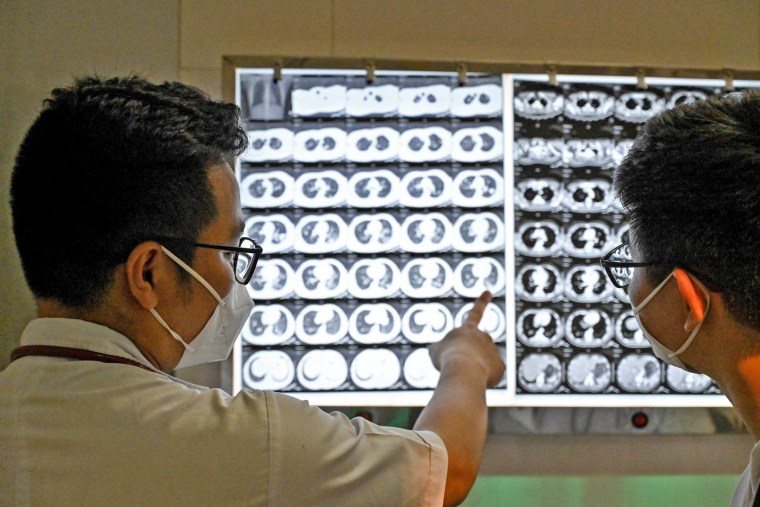 Doctors check the X -rays of a drug -resistant tuberculosis patient 