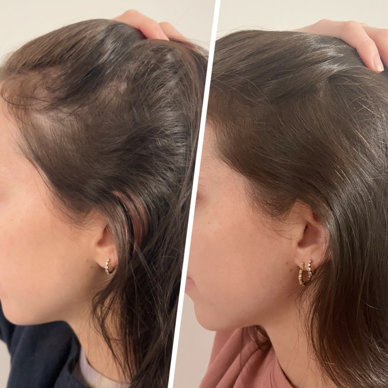 Commerce editor and producer Julie Ricevuto before and after using a 3-step system for hair loss.