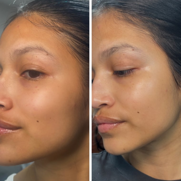 On the left, a woman takes a picture of acne on her cheek and forehead. On the right, a woman takes a picture of her skin the following morning after spraying Magic Molecules The Solution.