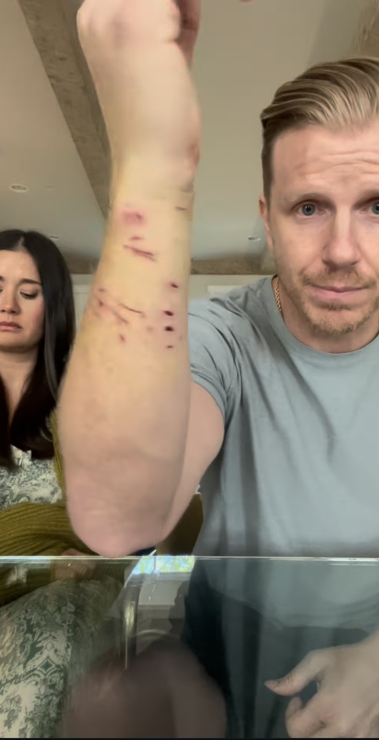 Sean Lowe shows his bite marks from the second time his dog attacked him.