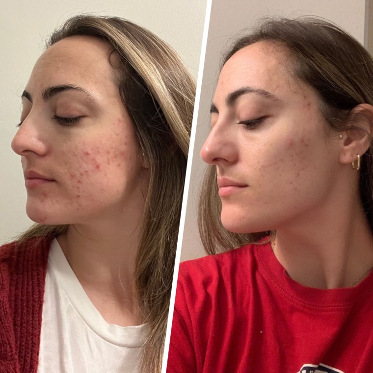 Before and after using the Innisfree Green Tea Enzyme Vitamin C Brightening Toner Pads.