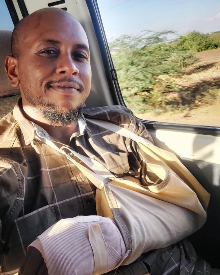 Amr Ali después de recibir tratamiento para su mano, que se rompió cuando fue golpeado en cautiverio de RSF.