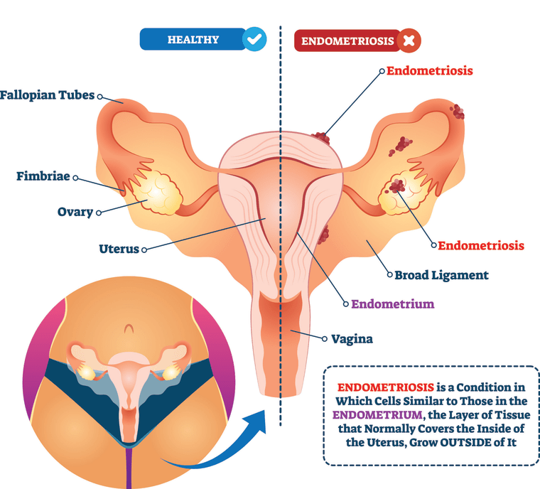 Endometriosis vector illustration