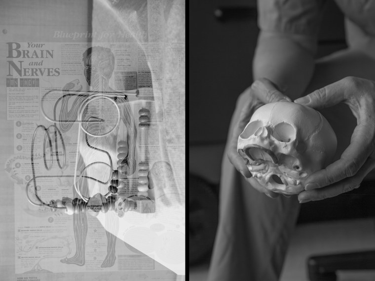 Left: A double exposure image of a child's toy a poster called "Your Brains and Nerves." Right, Dr. Mazzola with a model of an infant's skull.