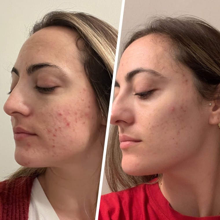 Audience development writer Danielle Murphy before and after using the Innisfree Green Tea Enzyme Vitamin C Brightening Toner Pads regularly for about two months.