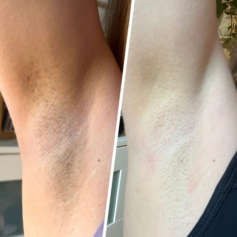 Results before (left) and after (right) using the device for nearly two months.