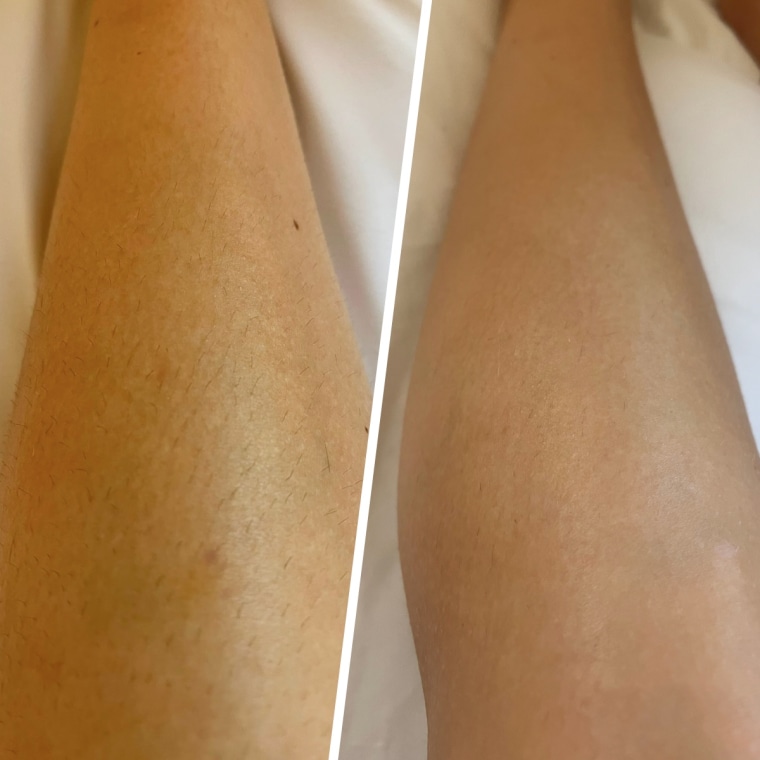 Results before (left) and after (right) using the Ulike Air for nearly two months.