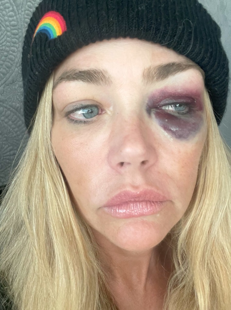 Denise Richards pinch a bruised eye.