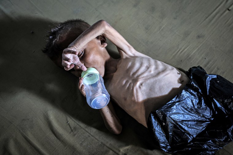 Malnourished toddler in Gaza fights for life amid ongoing Israeli attacks