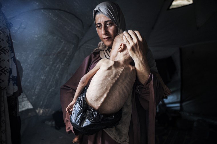 DO NOT USE - max Muhammad Zakariya Ayyoub al-Matouq, a 1.5-year-old child in Gaza City, Gaza, faces life-threatening malnutrition as the humanitarian situation worsens due to ongoing Israeli attacks and blockade, on July 21, 2025.