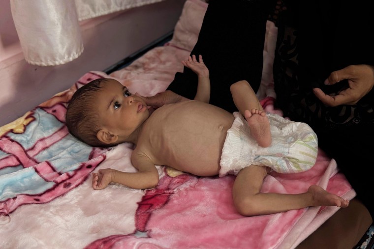 Children starving in Gaza