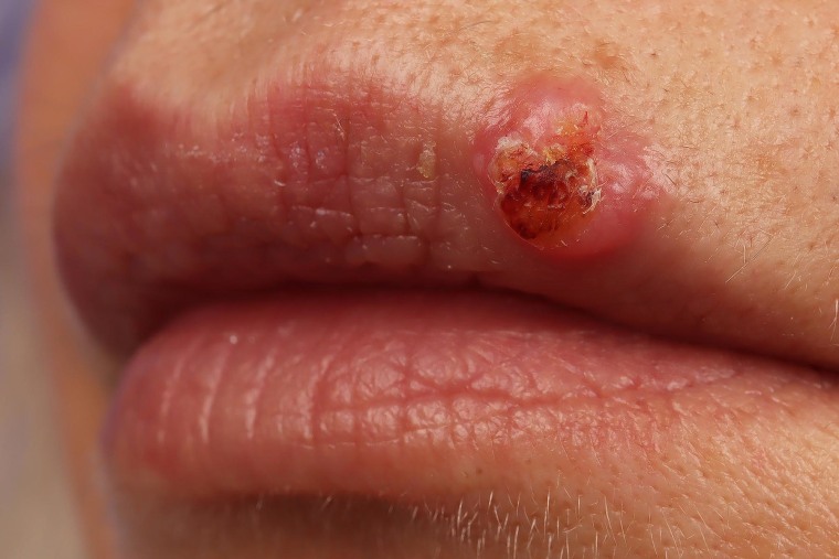 A type of HPV can cause skin cancer in people with weakened immune systems, report finds