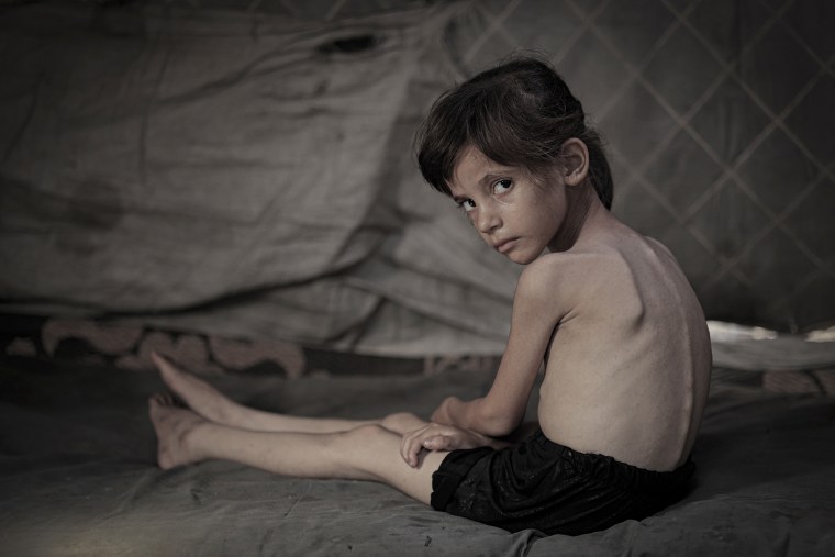 Debido a la falta de alimentos, ha caído a solo 8 kilogramos, y su salud continúa deteriorándose. Su familia está pidiendo ayuda urgente para garantizar que reciba un tratamiento y nutrición adecuados. (Foto de Mohammed YM al-Yaqoubi/Anadolu a través de Getty Images)