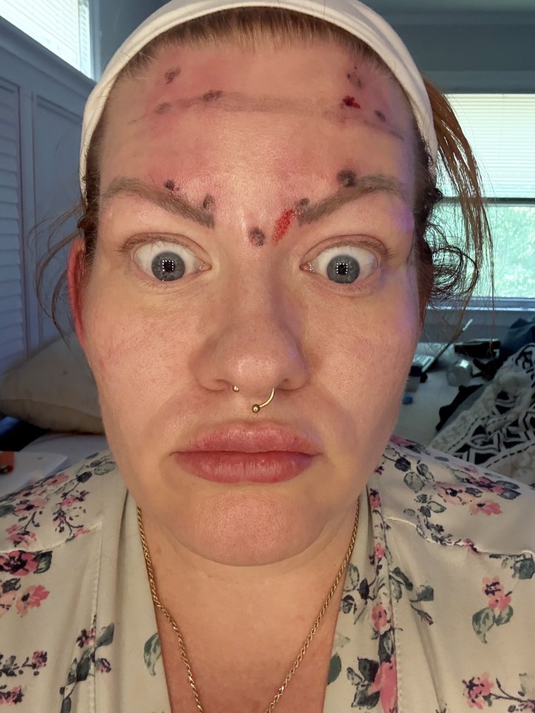 Kelly Keene has self-injected Innotox a few times but for now is comfortable doing so only on the top part of her face.