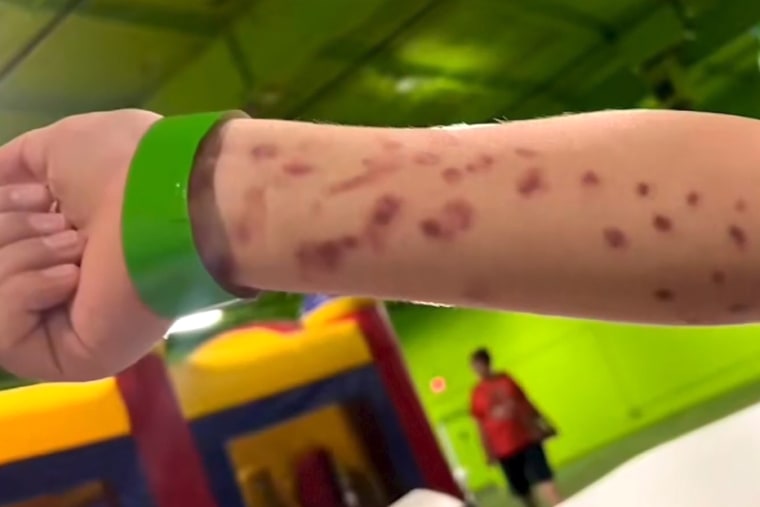 octopus marks