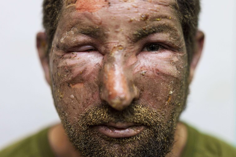 Burns are seen on the face of a Ukrainian soldier