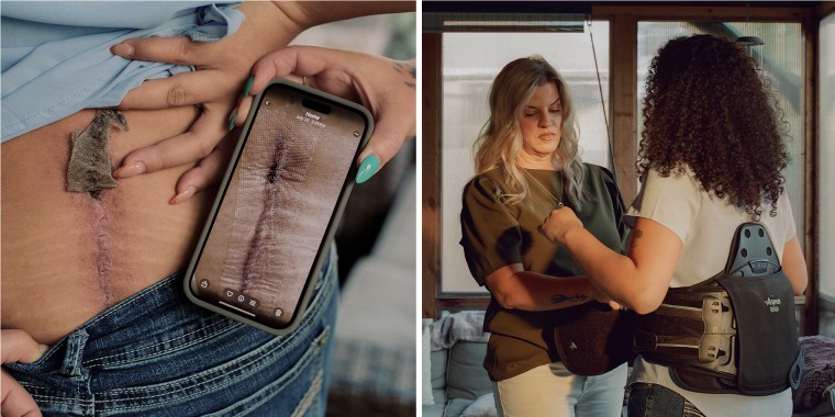 A split composite image of Nala White lifting up her shirt to reveal scars on her back next to a phone showing a photo of said scar, left, and Christine Byers helping Nala White adjust a back brace