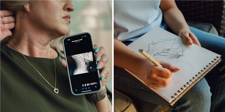 A split composite image showing Christine Byers, left, showing her neck scars and an x-ray image on her phone, and right, hands close up on a sketch on a drawing pad