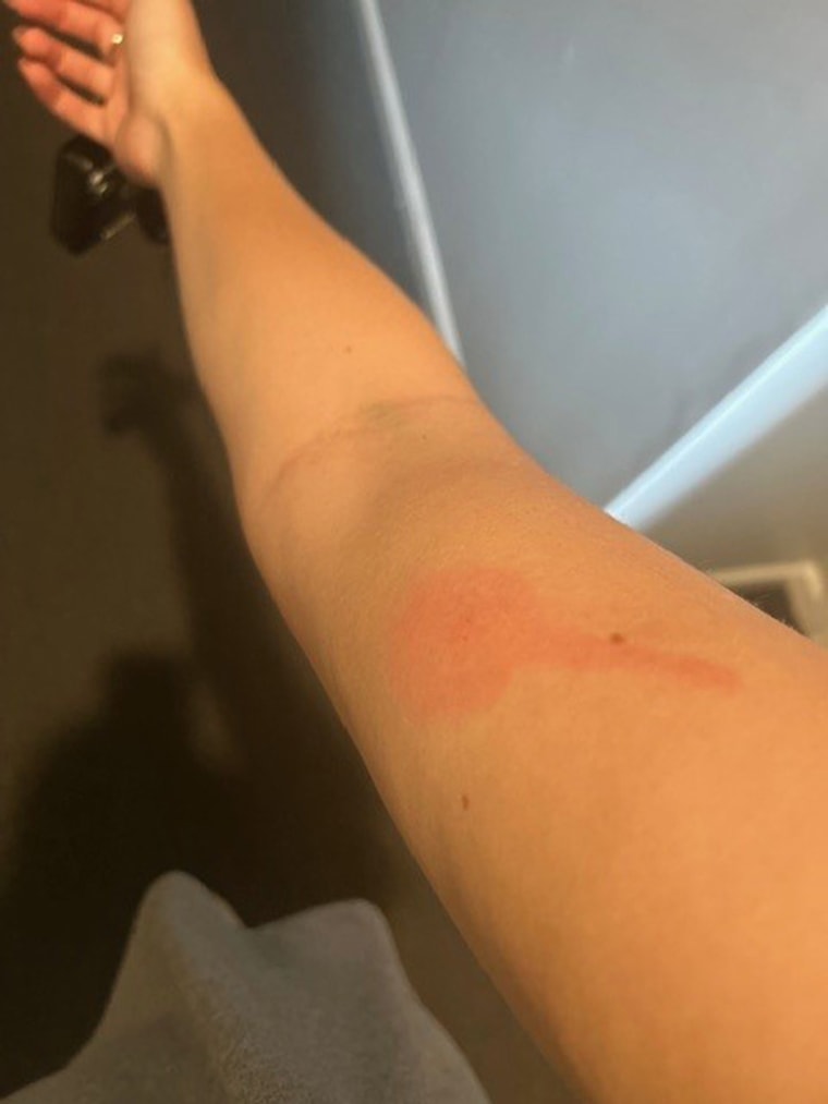 O morcego do bastão causou uma erupção cutânea no braço de Samantha Lang.