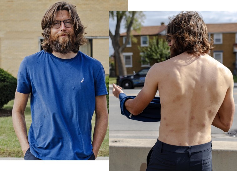 Levi Rolles, known as “Spicy Jesus,”shows the welts on his from repeated clashes with law enforcement.