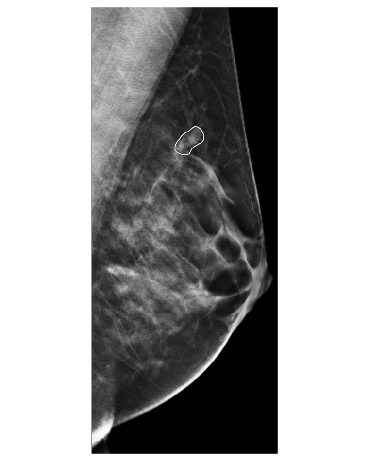 Uma radiografia de uma mama com uma massa circulada em branco