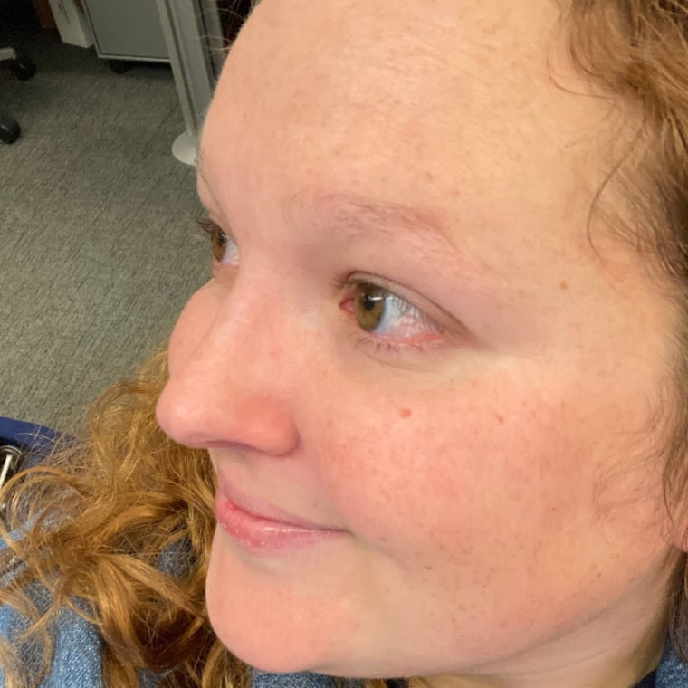 My skin now, where my POD flare-ups used to be. 